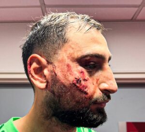 Assim ficou a cara do goleiro Donnarumma após sofrer uma entrada violenta do atacante Wilfried Singo, do Monaco. / Foto: Arthur Perrot