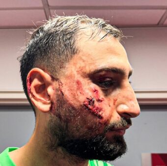 Assim ficou a cara do goleiro Donnarumma após sofrer uma entrada violenta do atacante Wilfried Singo, do Monaco. / Foto: Arthur Perrot